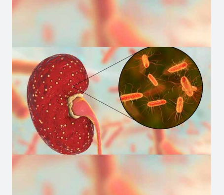 Síndrome Urémico Hemolítico: todo lo que tenés que saber