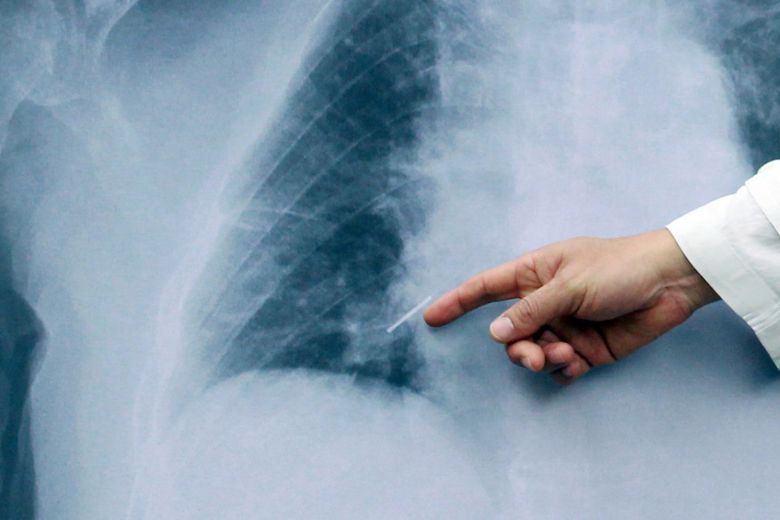 Neumonía bilateral: ¿Qué es y cuáles son sus síntomas? 