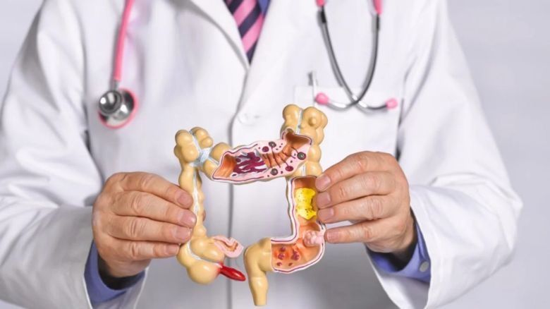 Cáncer de colon: se diagnostican en promedio más de 40 casos por día en la Argentina
